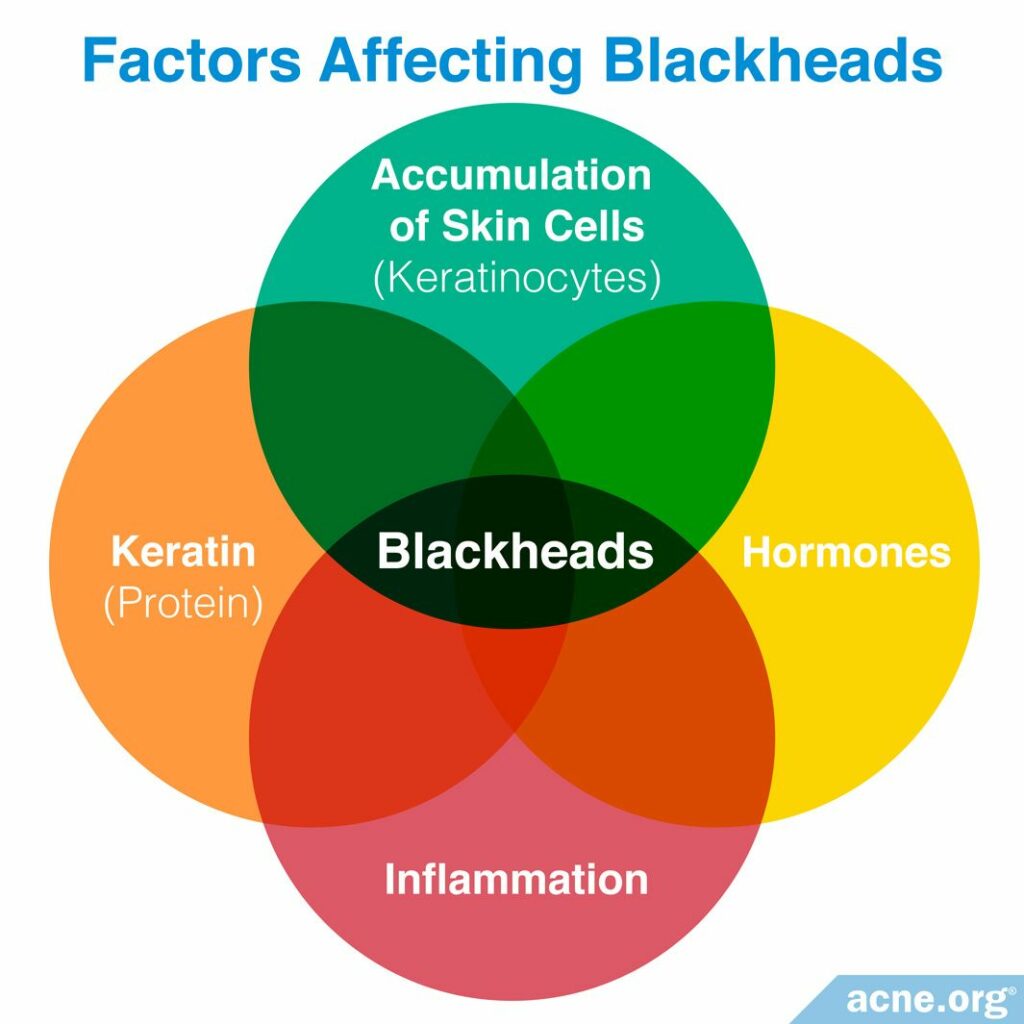 Factors Affecting Blackheads