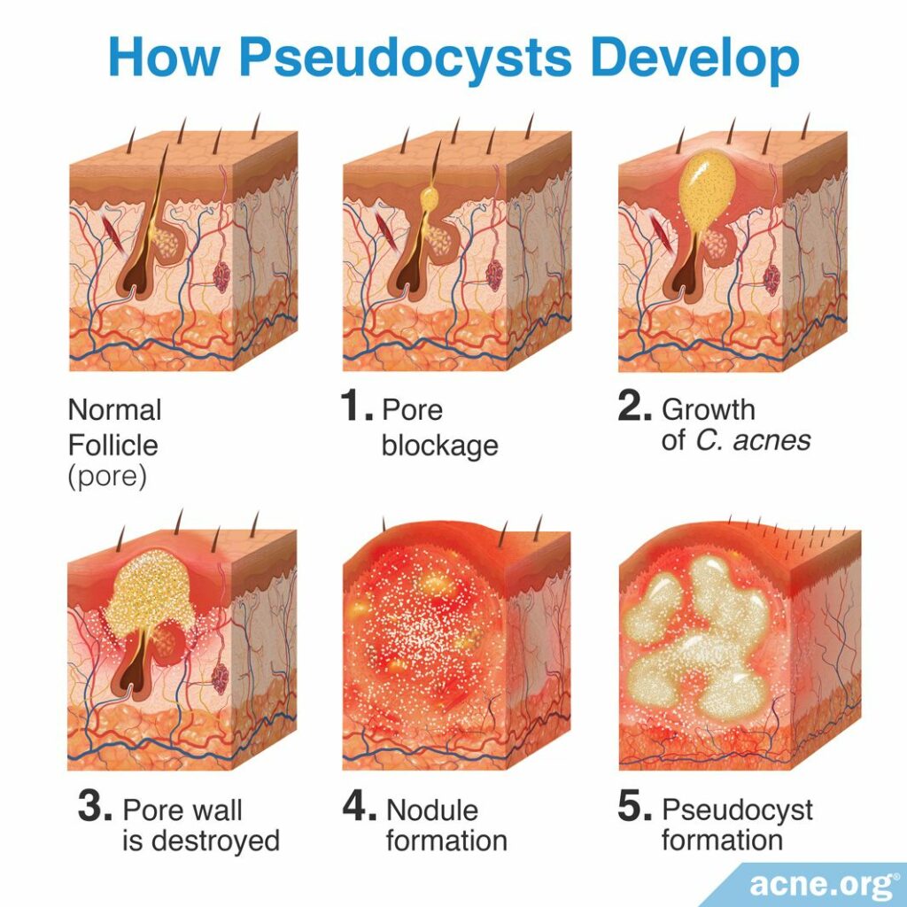 How Pseudocysts Develop