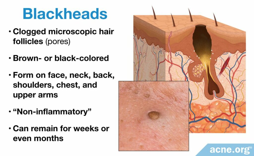 Blackheads