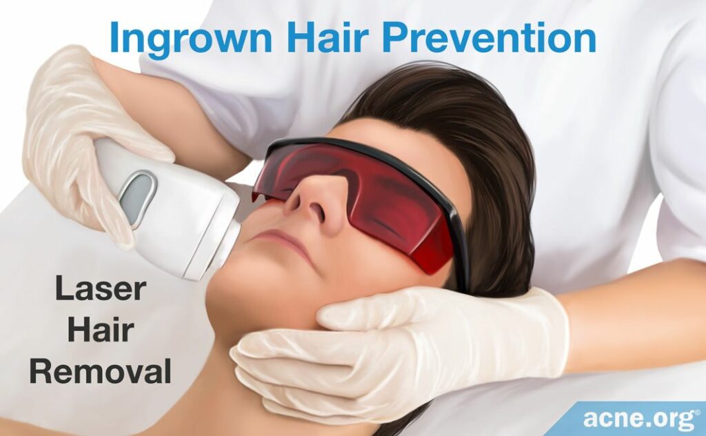 Ingrown Hair Prevention Laser Hair Removal