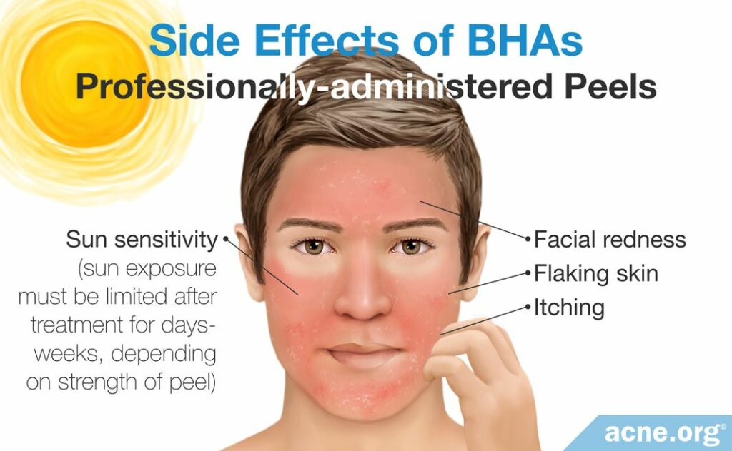 Side Effects of Professionally-administered BHA Peels
