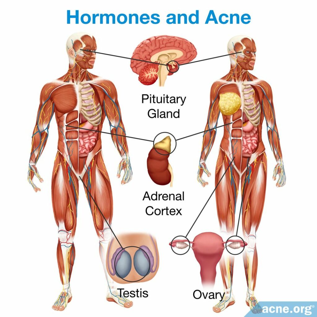 Hormones and Acne