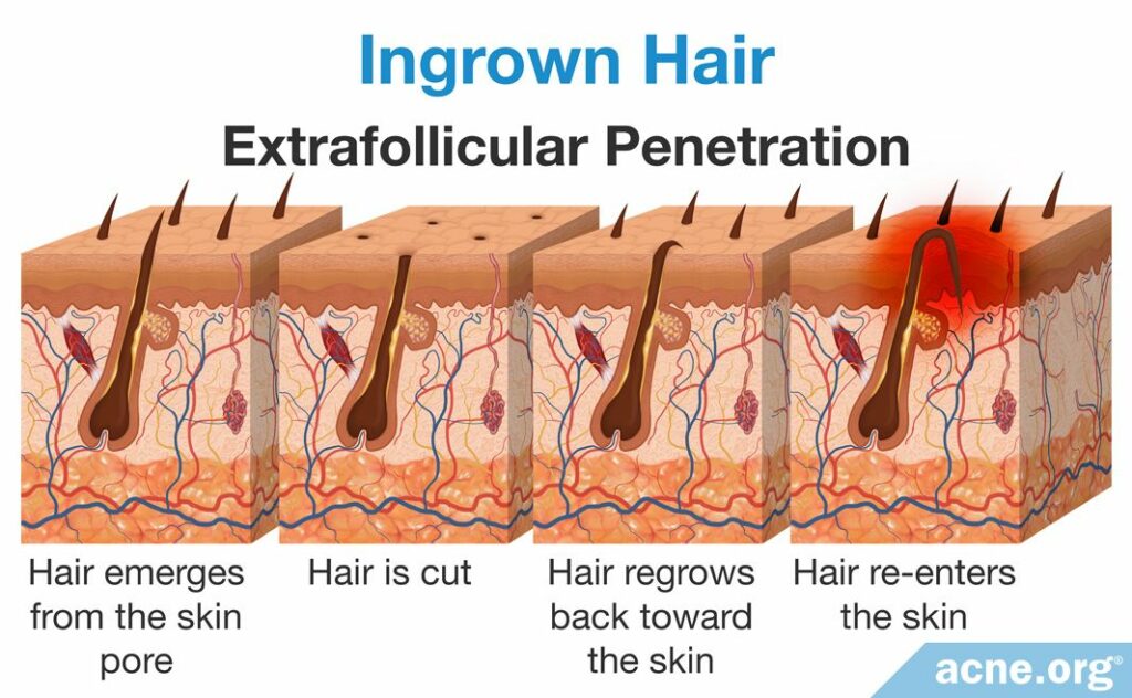 Ingrown Hair Extrafollicular Penetration