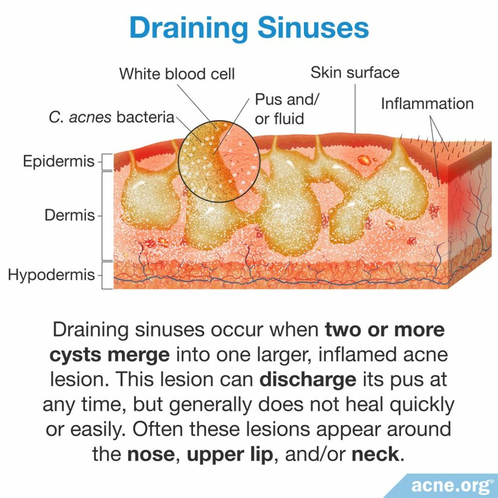 Draining Sinus