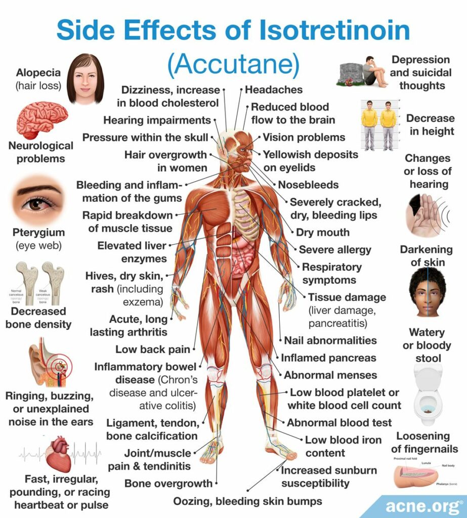 Side Effects of Isotretinoin (Accutane)