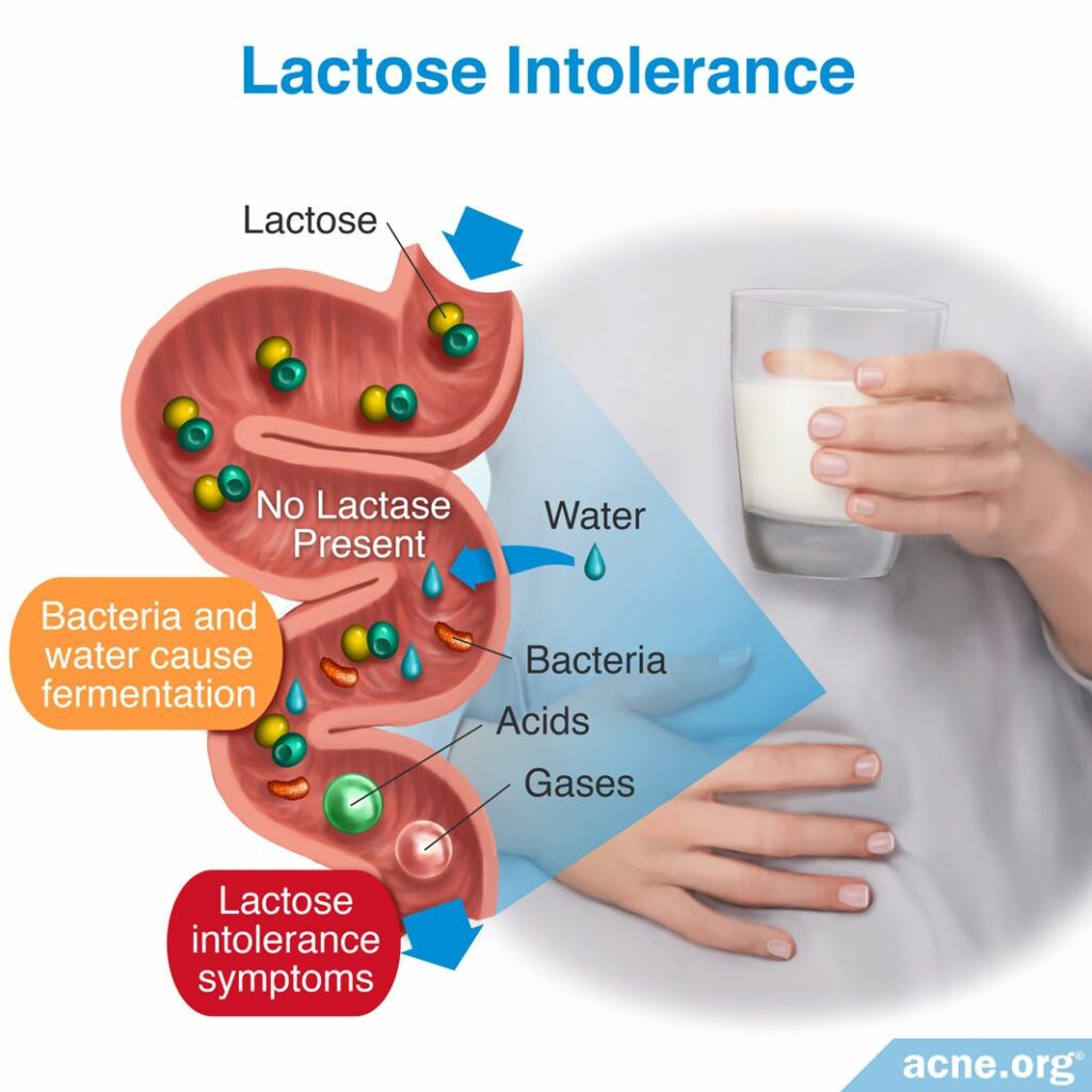 Lactose Intolerance