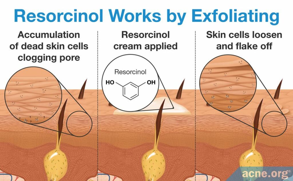 Resorcinol Works by Exfoliating