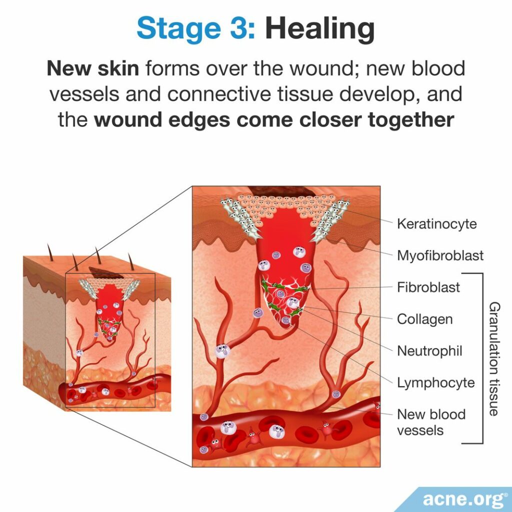 Stage 3 - Healing
