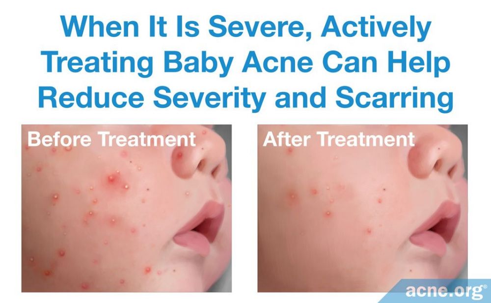 When It Is Severe, Actively Treating Baby Acne Can Help Reduce Severity and Scarring