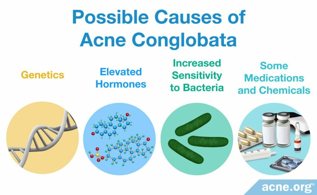 Possible Causes of Acne Conglobata