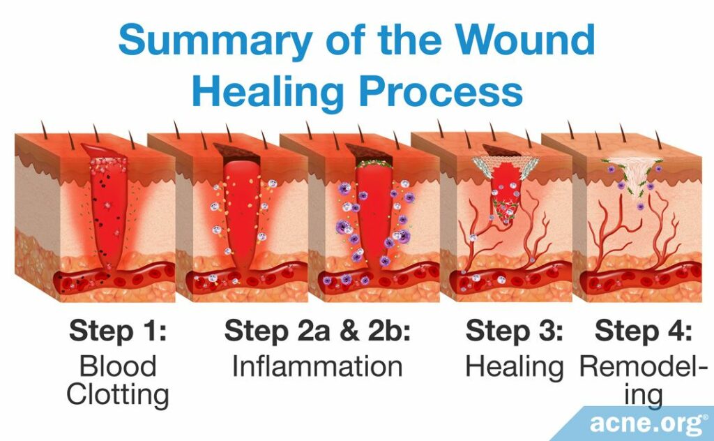 Summary of the Wound Healing Process