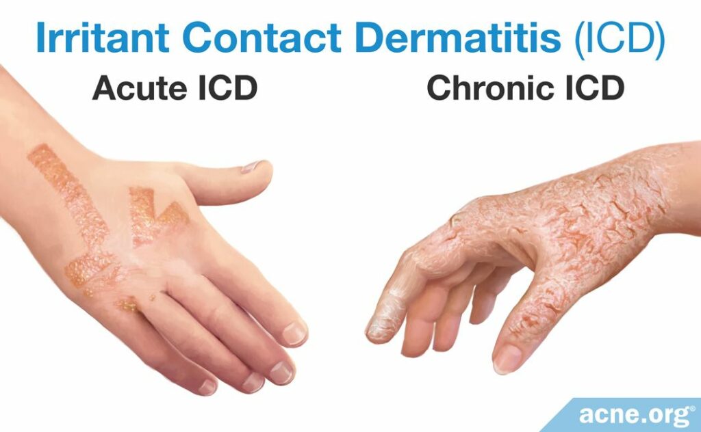 Irritant Contact Dermatitis (ICD) Acute ICD and Chronic ICD
