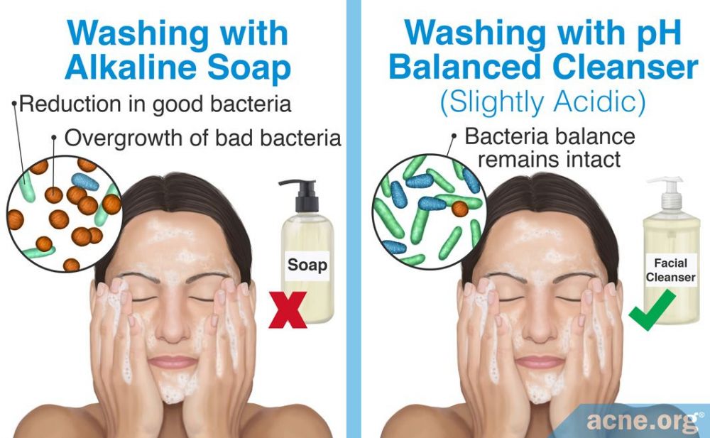 Washing with Alkaline Soap Vs pH Balanced Cleanser