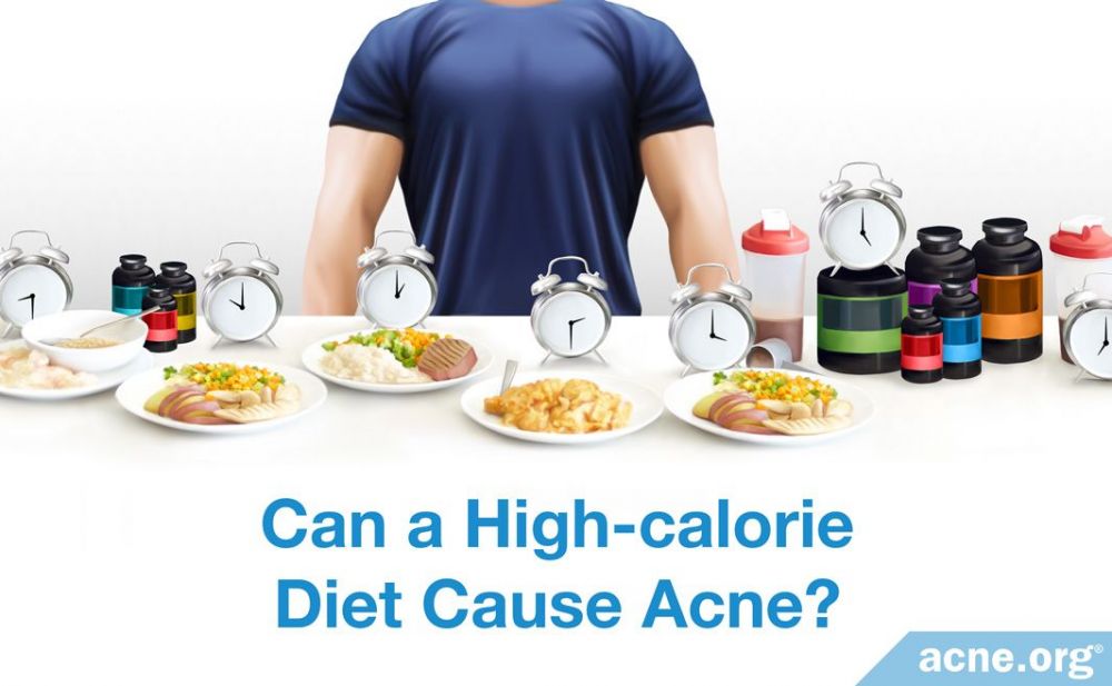 Can a High-calorie Diet Cause Acne