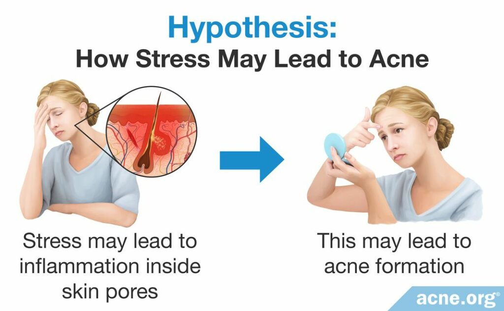 Hypothesis - How Stress May Lead to Acne