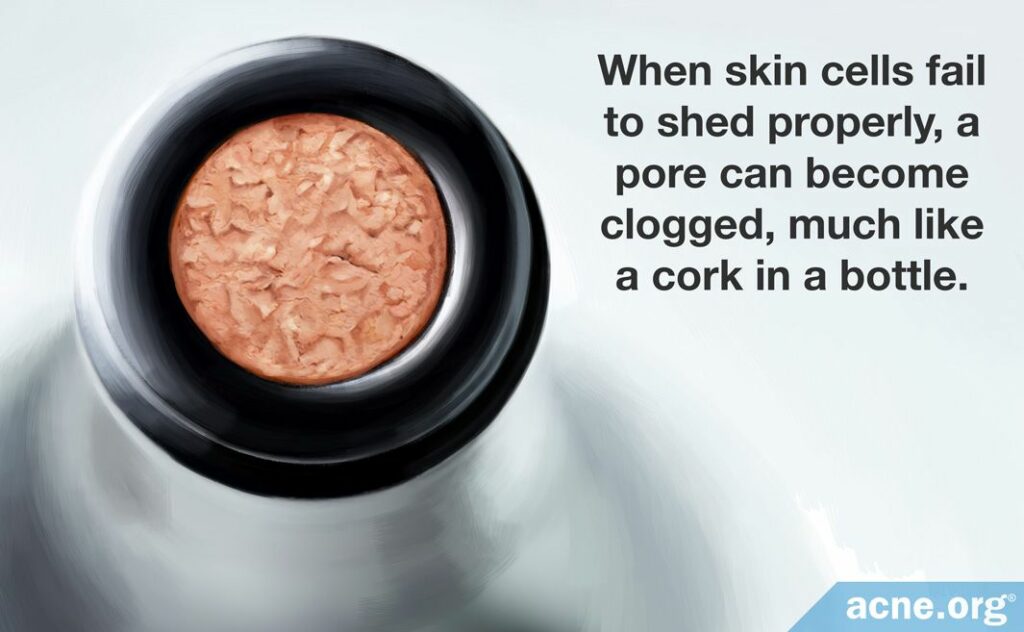When skin cells fail to shed properly, a pore can become clogged, much like a cork in a bottle.