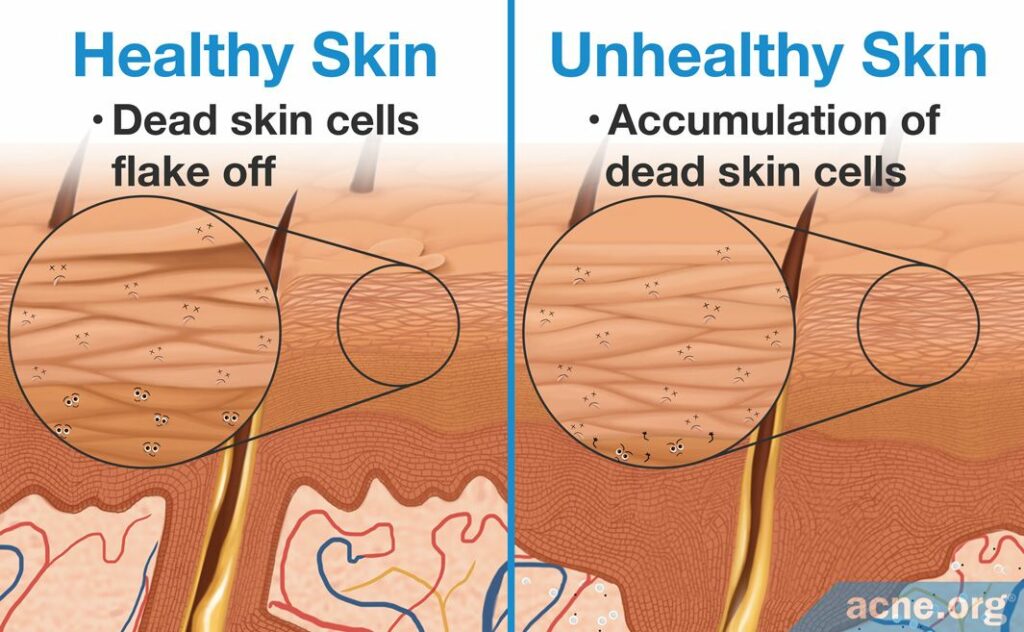 Healthy Skin Dead Skin Cells Flake Off Vs Unhealthy Skin Accumulation of Dead Skin Cells