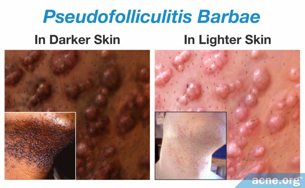 Pseudofolliculitis Barbae