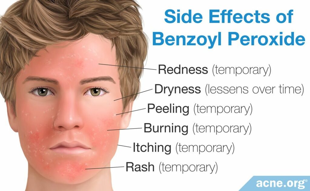 Side Effects of Benzoyl Peroxide