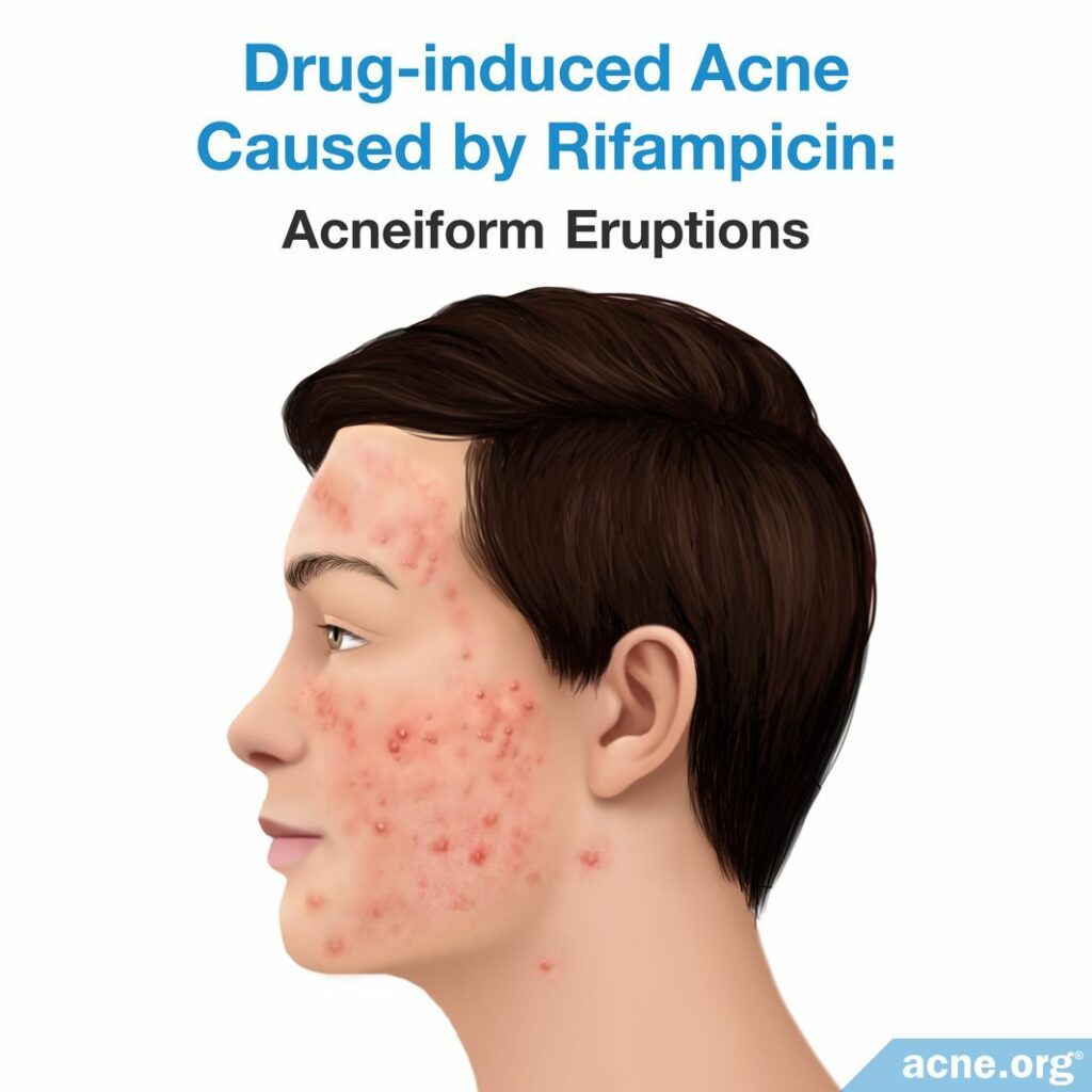 Drug-induced Acne Caused by Rifampicin