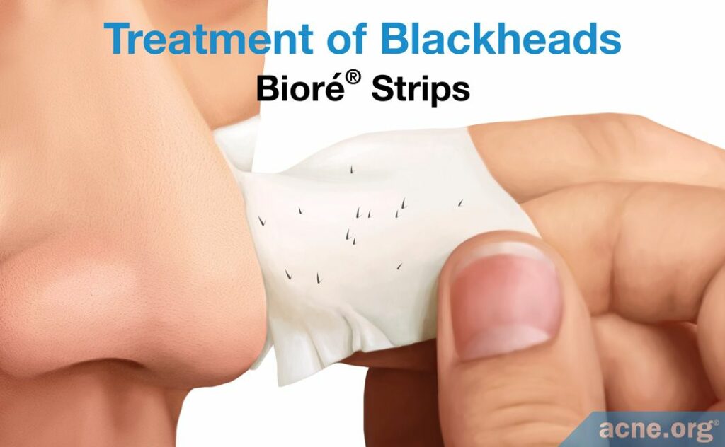 Treatment of Blackheads Biore Strips