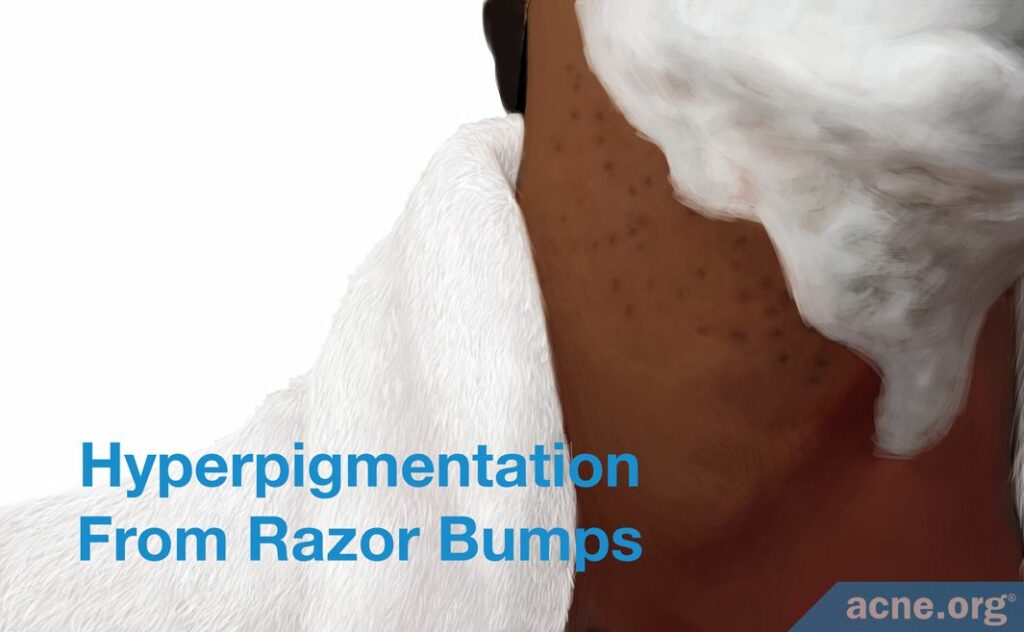 Hyperpigmentation From Razor Bumps