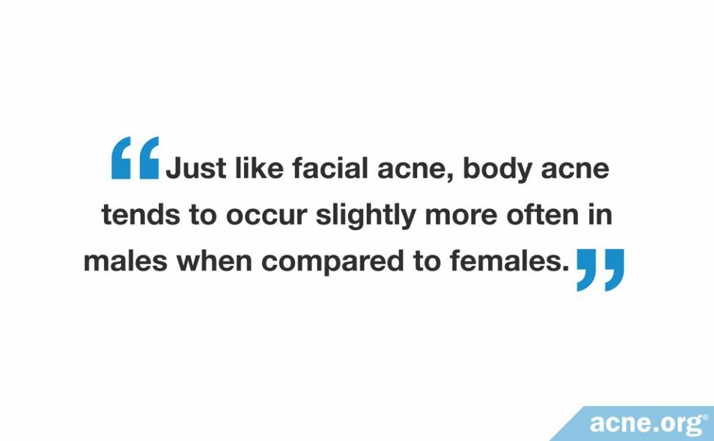 Just like facial acne, body acne tends to occur slightly more often in males when compared to females.