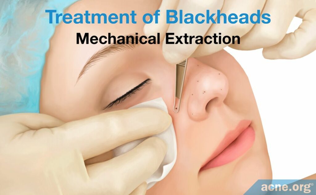 Treatment of Blackheads Mechanical Extraction