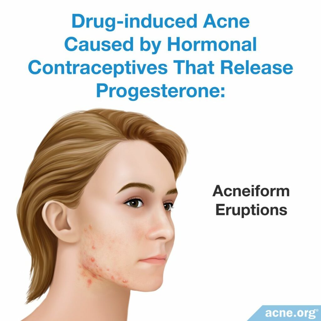 Drug-induced Acne Caused by Hormonal Contraceptives That Release Progesterone
