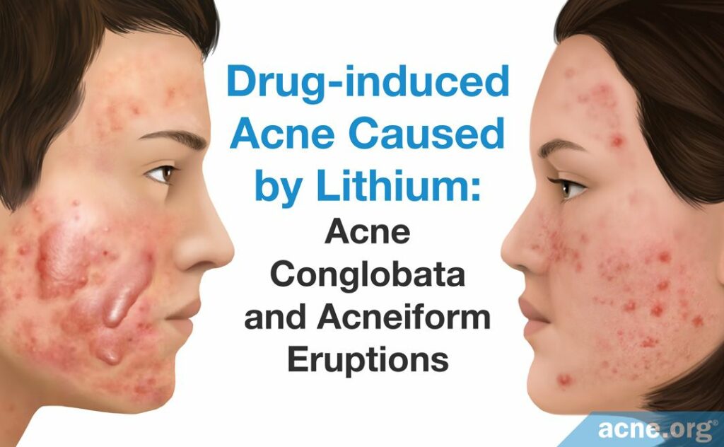 Drug-induced Acne Caused by Lithium