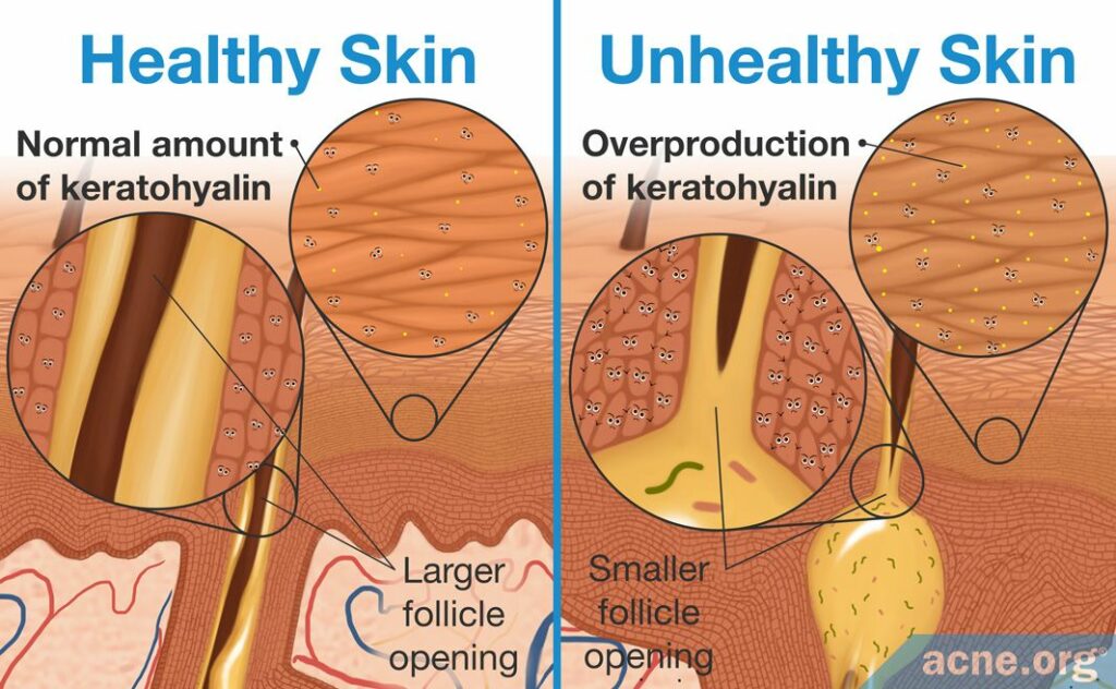 Healthy Skin with Normal Amount of Keratohyalin Vs Unhealthy Skin with Overproduction of Keratohyalin