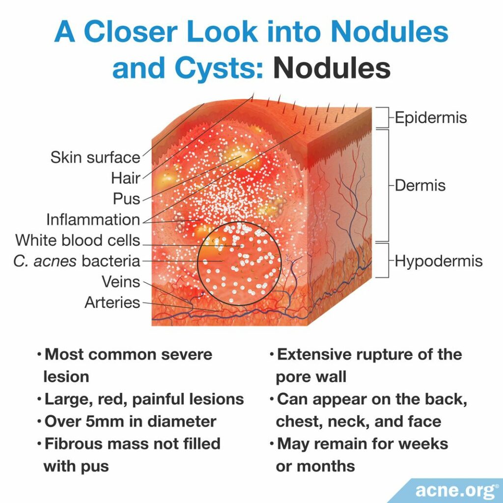 Acne Nodule