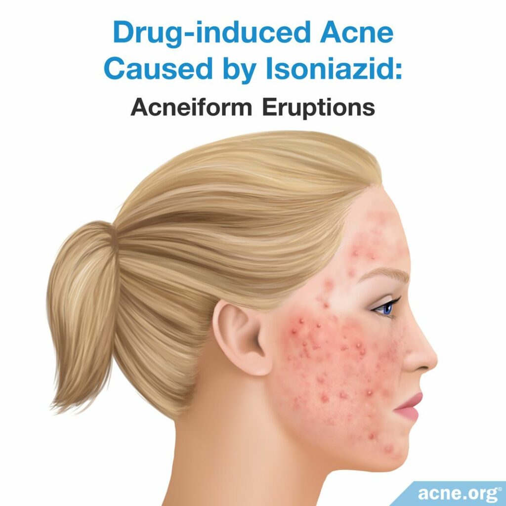 Drug-induced Acne Caused by Isoniazid