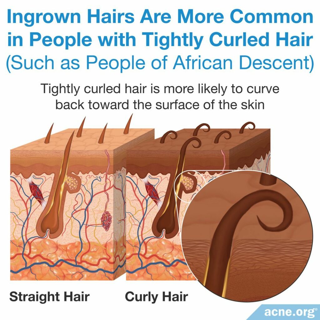 Ingrown Hairs Are More Common in People with Tightly Curled Hair