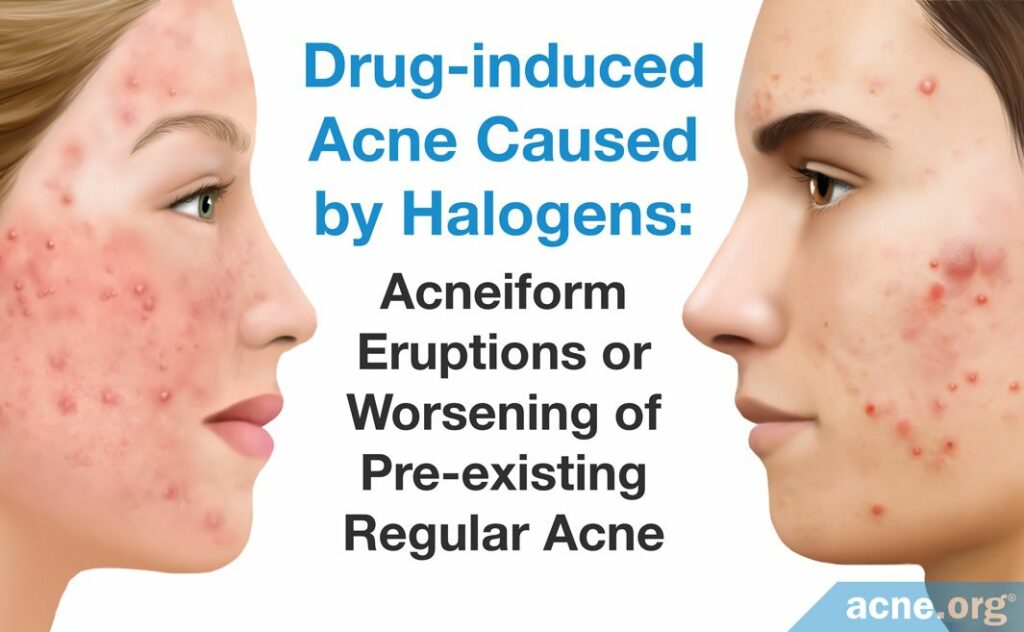 Drug-induced Acne Caused by Halogens