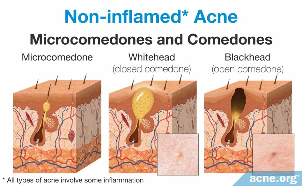 Non-inflamed Acne Microcomedones and Comedones