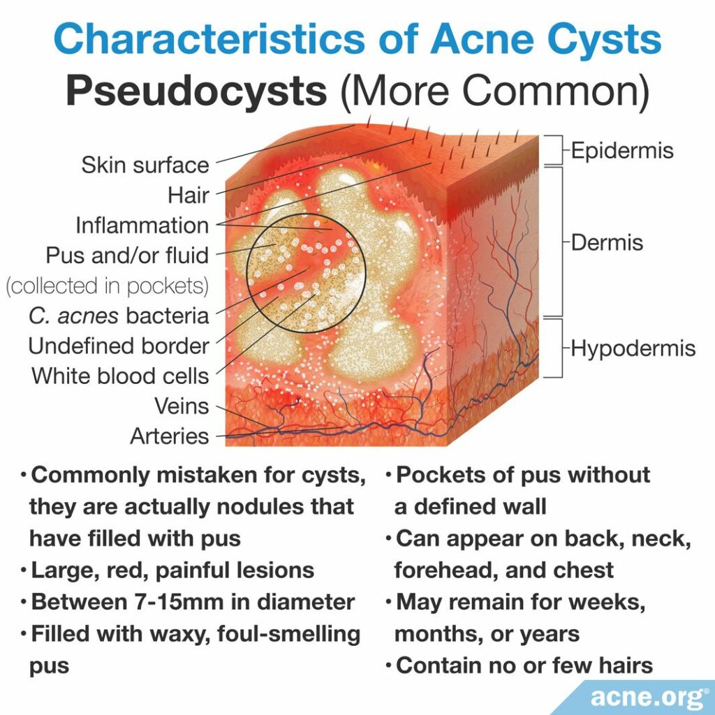 Characteristics of Acne Cysts Pseudocysts