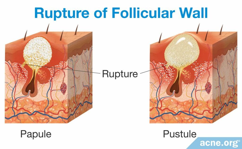 Rupture of Follicular Wall