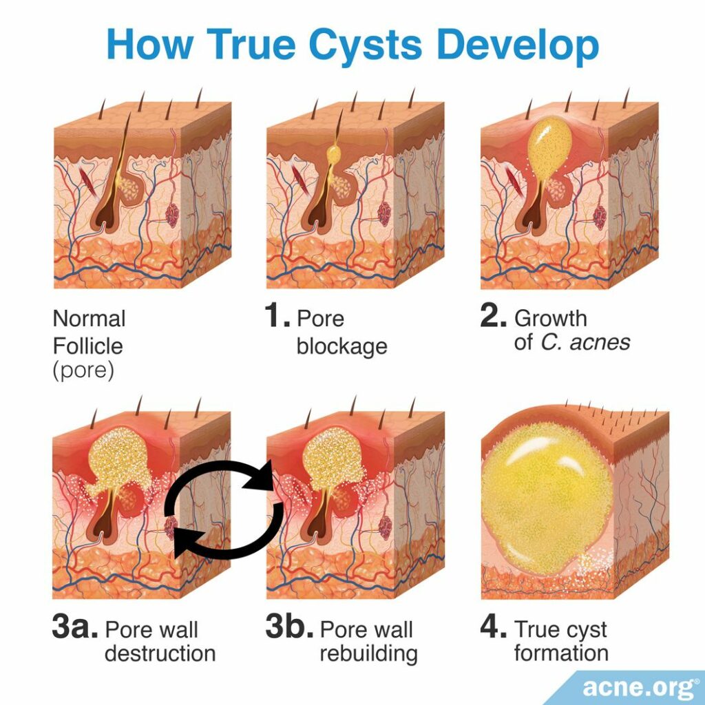 How True Cysts Develop