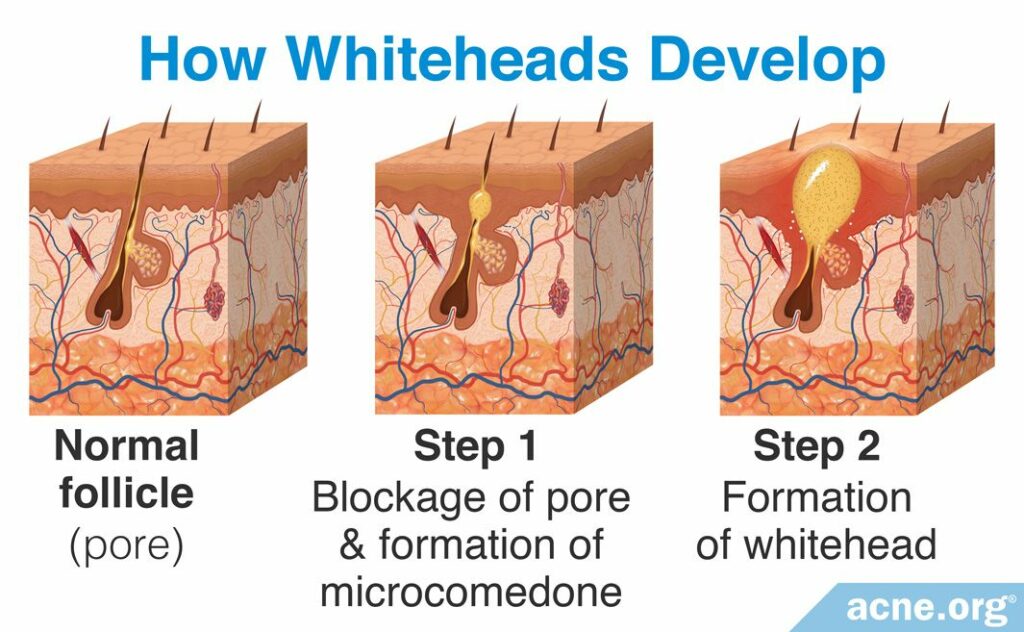 How Whiteheads Develop