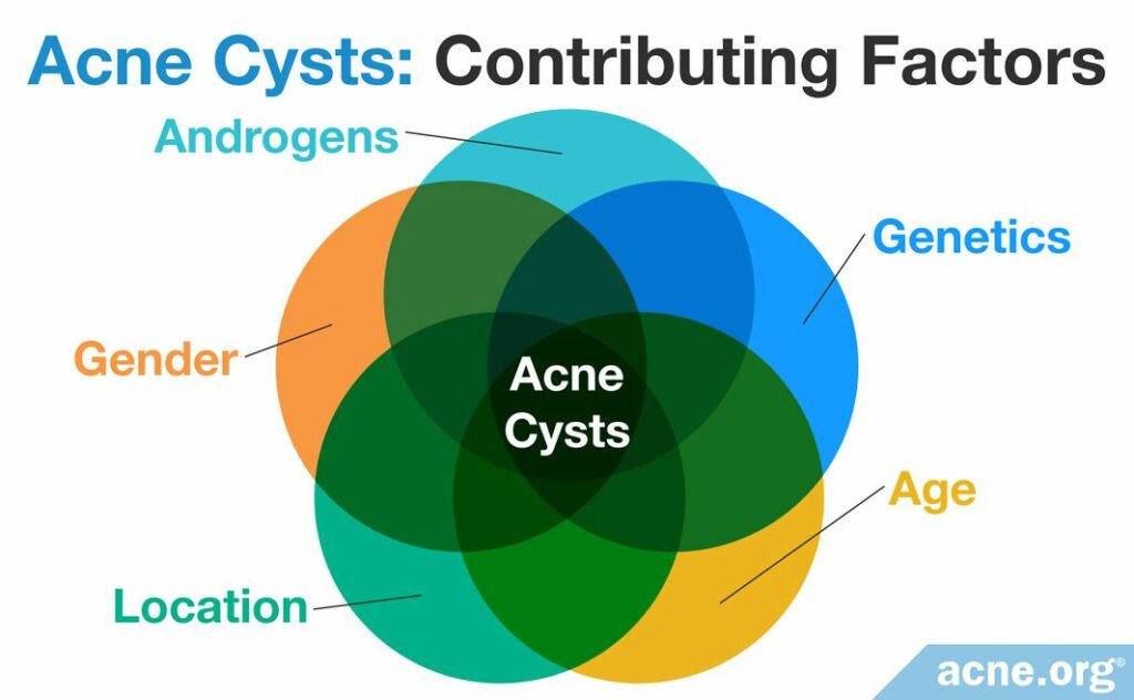 Contributing Factors to Acne Cysts