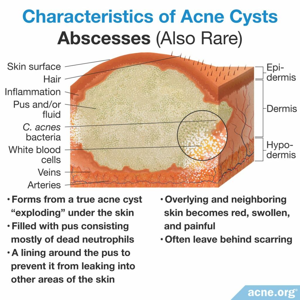 Characteristics of Acne Cysts Abscesses