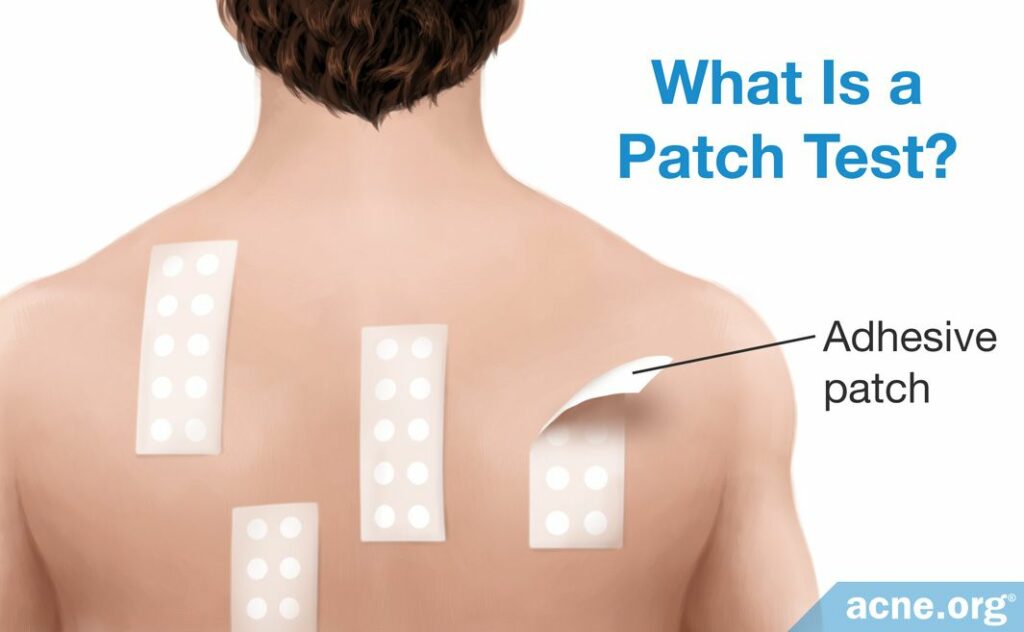 What Is a Patch Test?