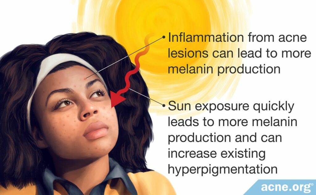 Inflammation from acne lesions can lead to more melanin