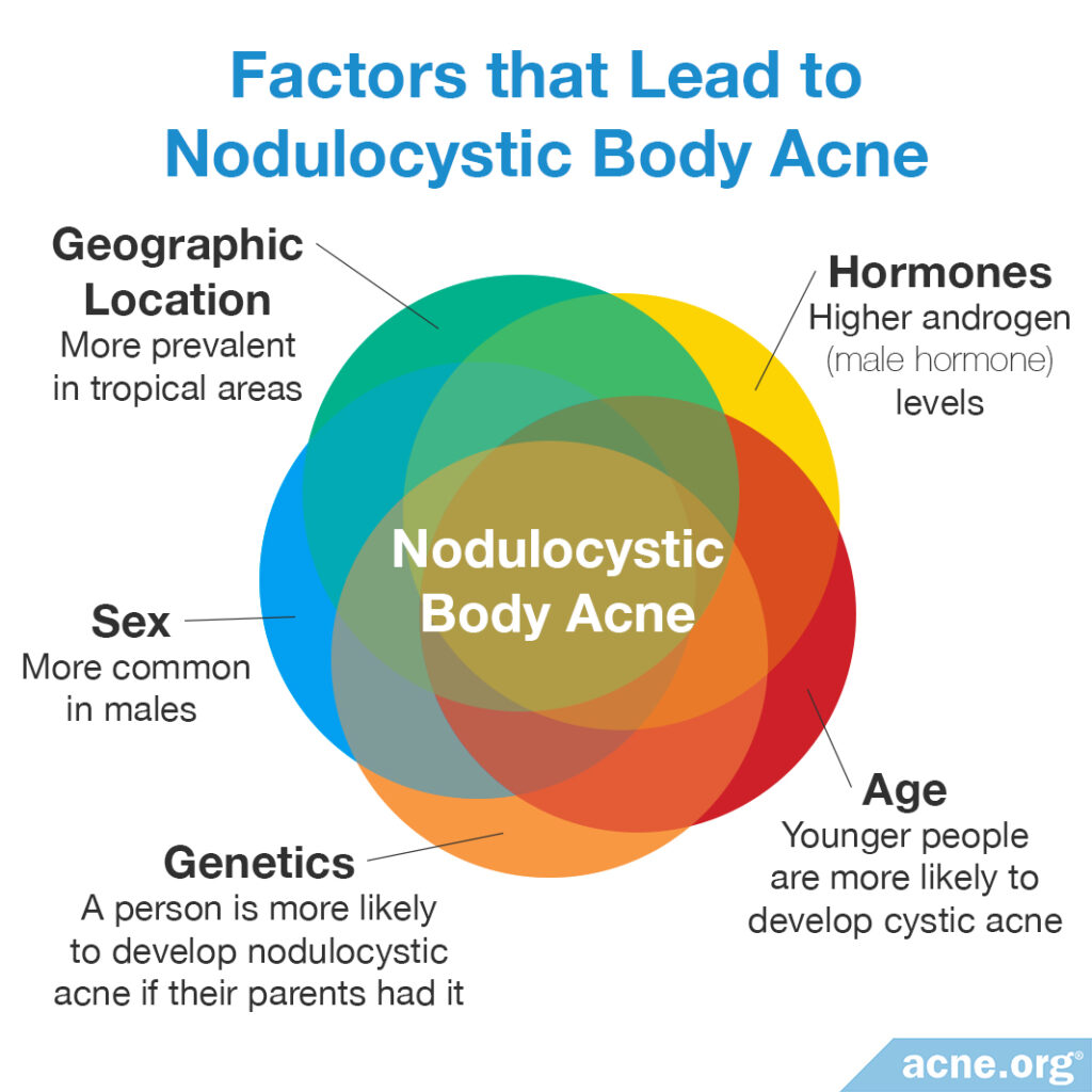 Factors that Lead to Nodulocystic Body Acne