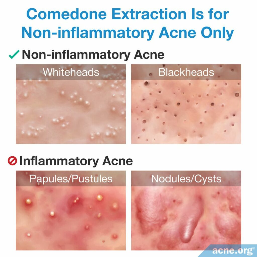 Comedone Extraction Is for Non-inflammatory Acne Only