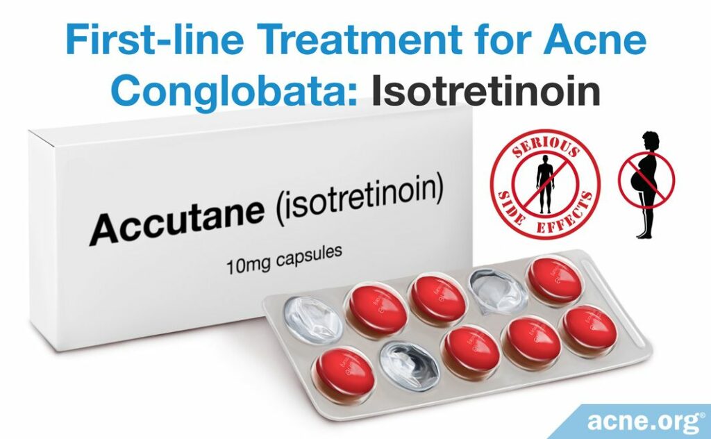 First-line Treatment for Acne Conglobata Isotretinoin