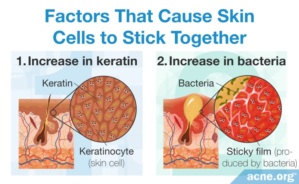 Factors That Cause Skin Cells to Stick Together