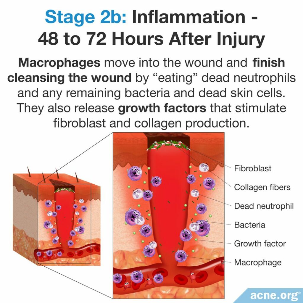 Stage 2b - Inflammation - 48 to 72 Hours After Injury