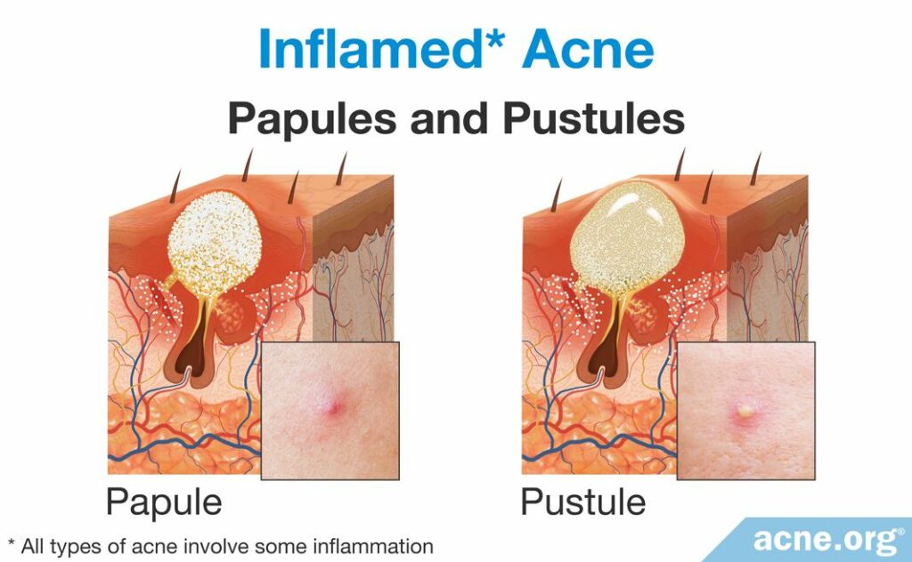 Inflamed Acne Papules and Pustules